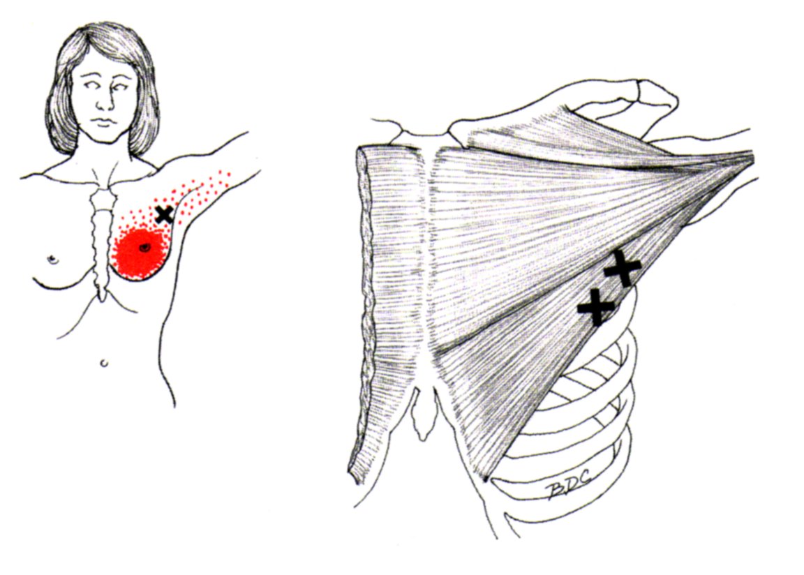 Pectoralis Major | The Trigger Point & Referred Pain Guide